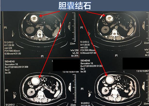 小胆囊也会有大麻烦!关于胆结石的3件事,你不妨了解一下