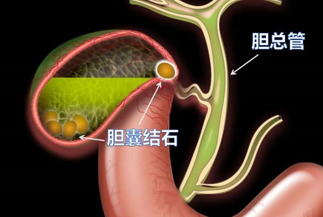 小胆囊也会有大麻烦!关于胆结石的3件事,你不妨了解一下