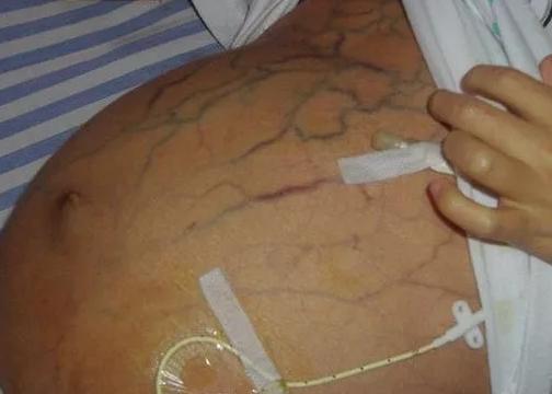 乙肝恶化成肝硬化的几率有多高?若是像他一样过度劳累,很快