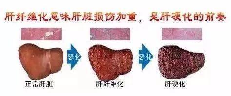 乙肝到肝硬化发展的快慢,延缓肝硬化的方法有哪些
