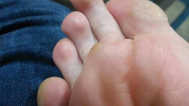 脚底上长了“鸡眼”怎么办?如果不管会自愈吗?告诉你靠谱办法