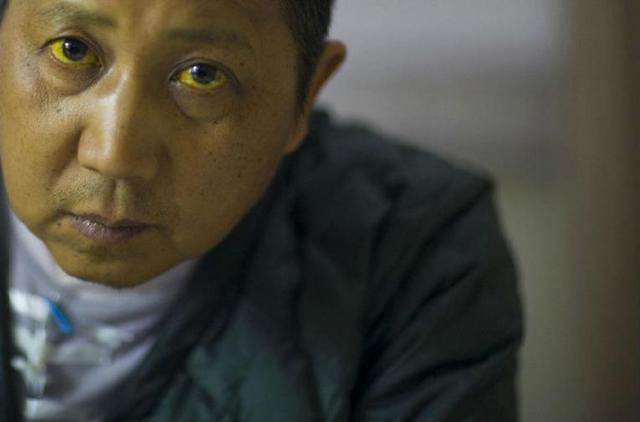 肝病多是"拖"出来的,"皮肤"若出现4种表现,趁早查肝功能
