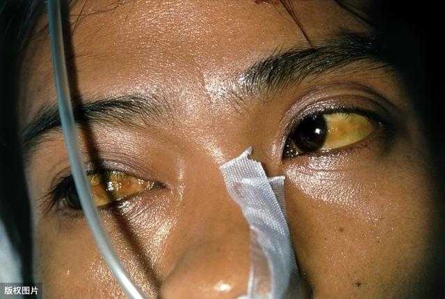 肝病是身体的“隐形杀手”,医生提醒:身体若出现2黄、2痒,警惕肝病来临