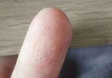 判断是否有湿气在体内,看手就知道,手上出现几个异常,不要拖