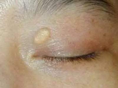 血管堵,脸先知,脸上出现3个迹象,提醒你该给血管洗洗澡了
