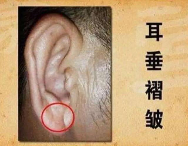 血管堵,脸先知,脸上出现3个迹象,提醒你该给血管洗洗澡了