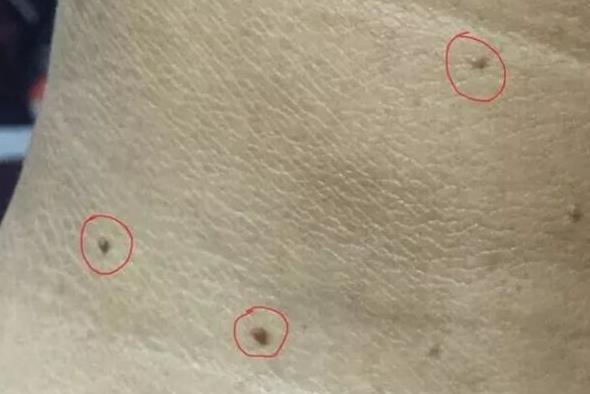 脖子长出“小肉粒”怎么回事?可能是这2种原因,别不当回事