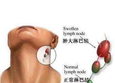肺不好的人,有“2处凸起,3处发黑”,若一个没有,肺部还算健康