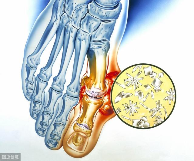 出现这3种现象,说明你的尿酸已经很高了