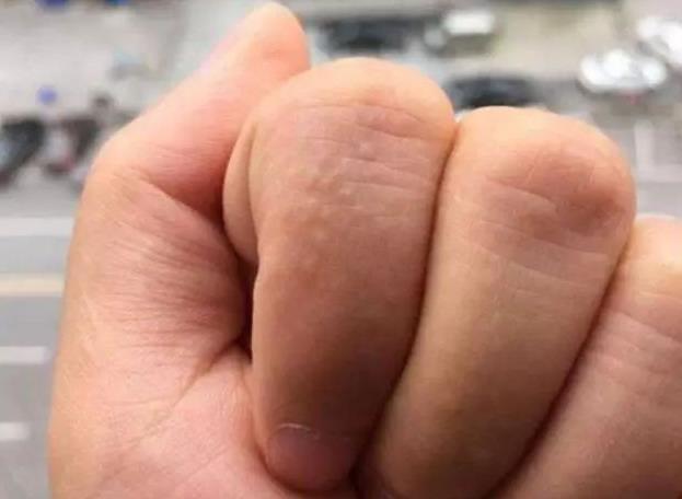 手上突然长出“小水泡”?这可能暗示了疾病,别不当回事