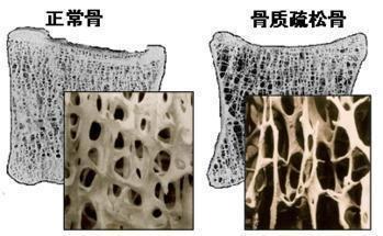 你知道吗,其实骨头汤、虾壳不补钙!请收下这份食物补钙排行榜
