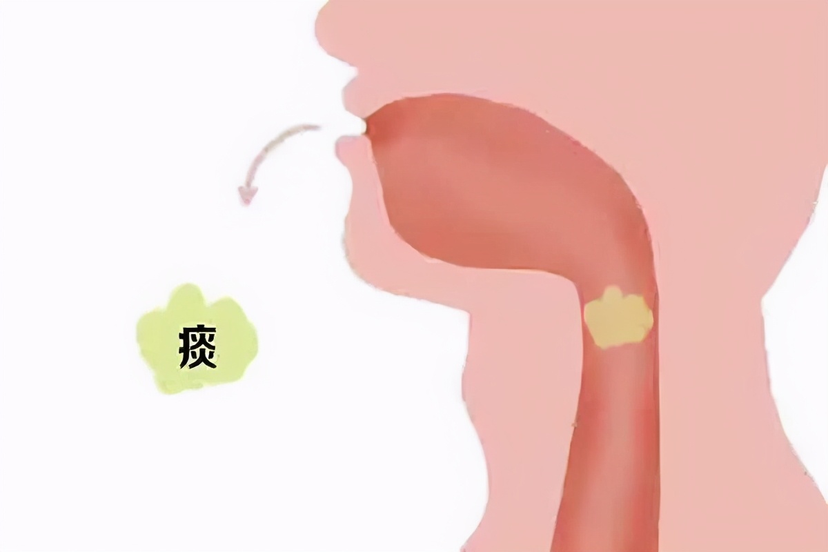 把痰咽下去,会不会让人生病?呼吸科医生为您进行通俗科普