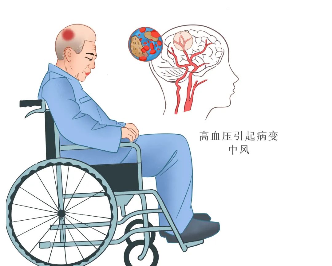 【慢病防控】每四个人中就会发生!这种疾病重在预防!