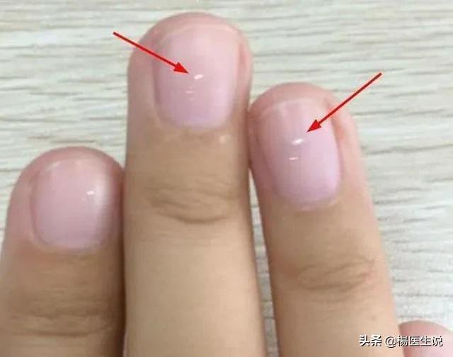 指甲上的“月牙”越多越健康?真的是这样吗?一次性说清楚!