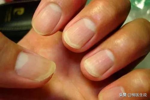 指甲上的“月牙”越多越健康?真的是这样吗?一次性说清楚!