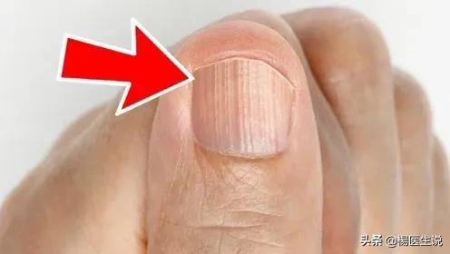 指甲上的“月牙”越多越健康?真的是这样吗?一次性说清楚!