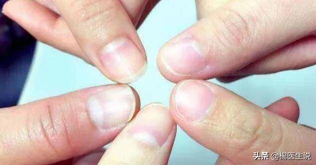 指甲上的“月牙”越多越健康?真的是这样吗?一次性说清楚!
