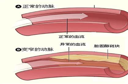 糖尿病前期不是糖尿病,对身体没有什么不良影响!医生辟谣讲清楚
