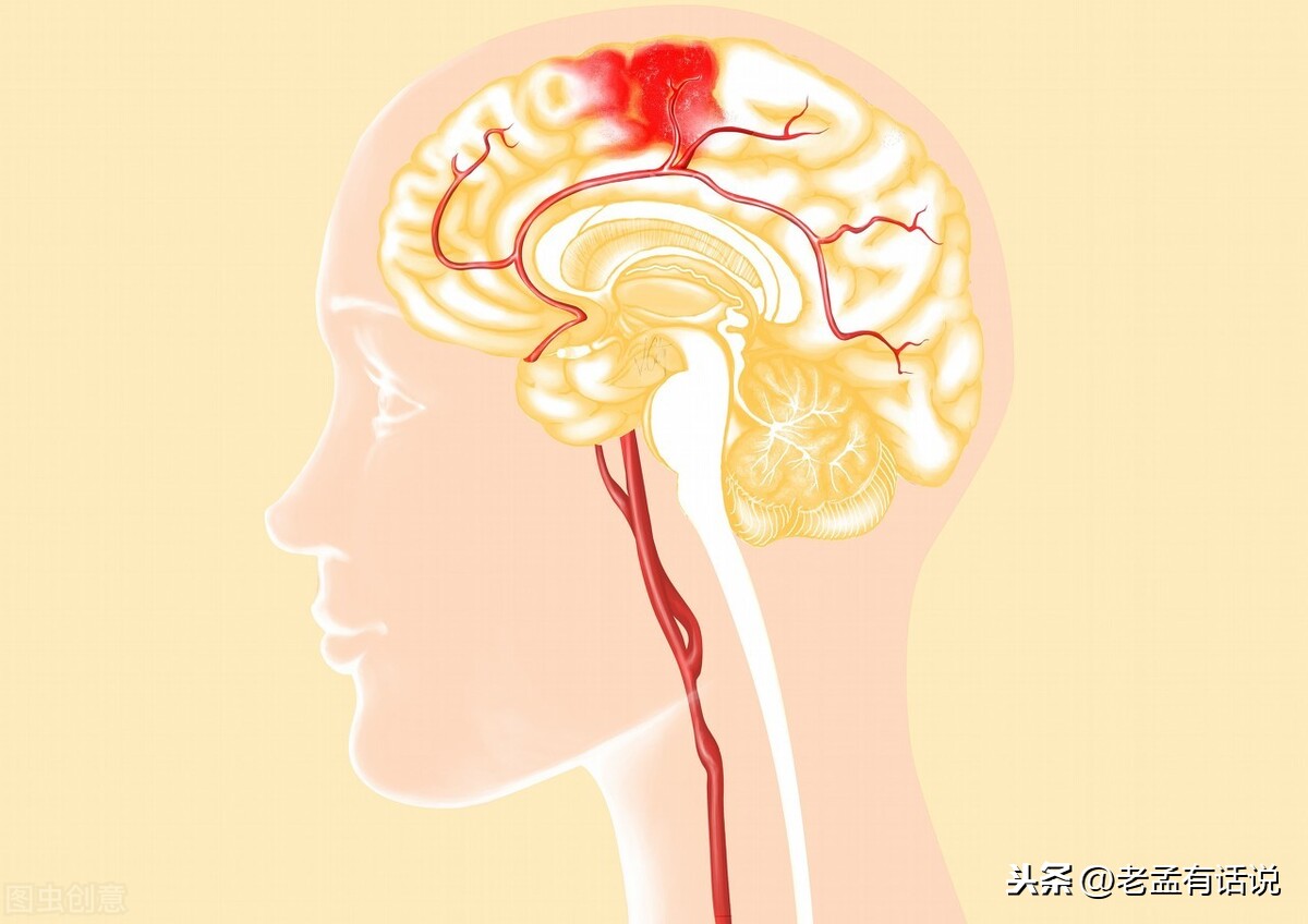 如何预防脑出血?首先要做好以下三点