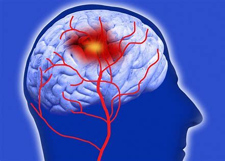 血压多高会引发脑出血，要注意什么才可有效预防？医生为您讲清楚