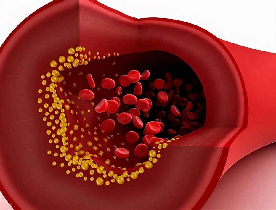 胆固醇高引发心梗脑梗，控制在正常范围就可避免！医生辟谣讲清楚