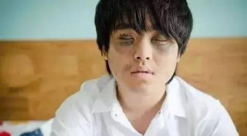 肝不好的人,眼睛会出卖你!警惕这些信号