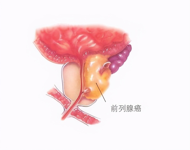 前列腺癌也会“找上”中年男性?这些事情做多了,说不好