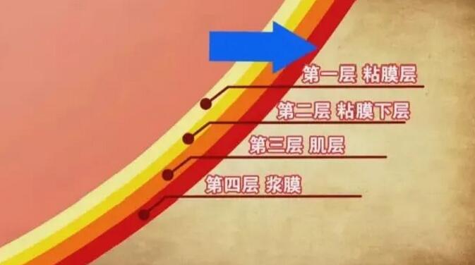 为什么会有人得胃溃疡?得了胃溃疡该怎么吃?