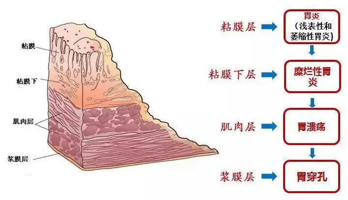 慢性胃炎怎么“养”护?