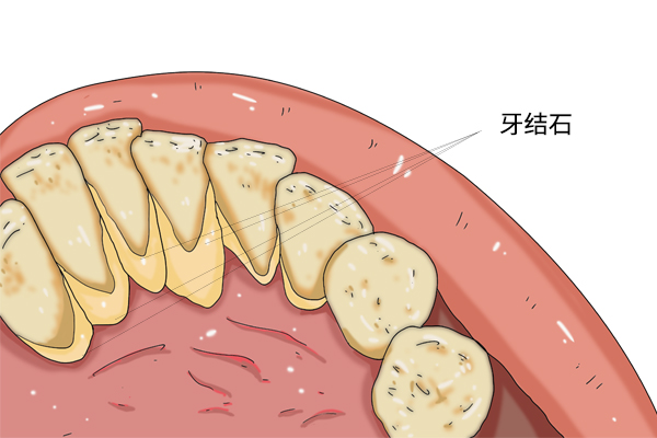 起床后,嘴巴干涩发苦,味道重,是怎么回事?如何调理?