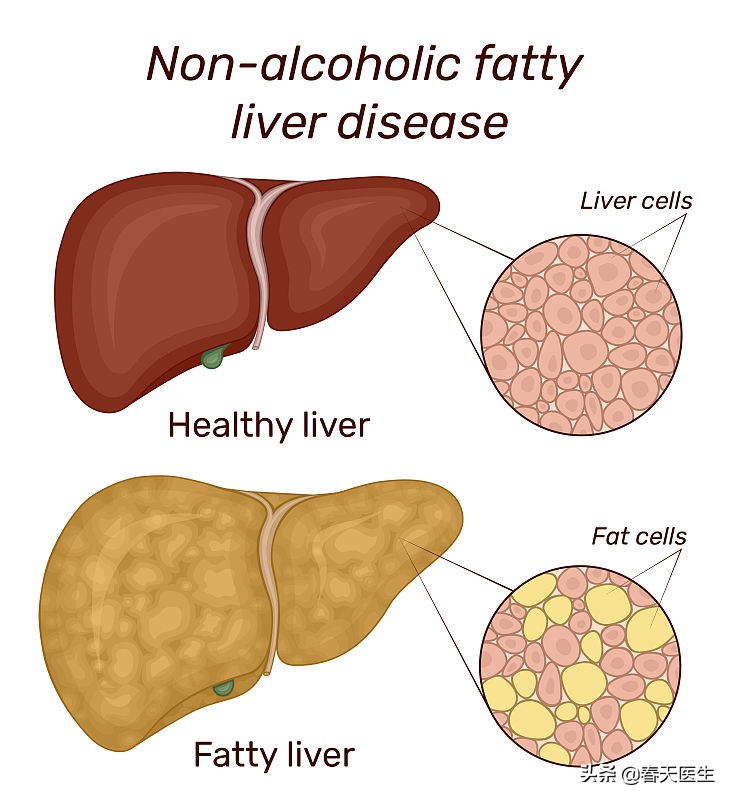 哪种糖最对身体危害最大？研究：果糖、蔗糖不降低脂肪肝肝癌几率