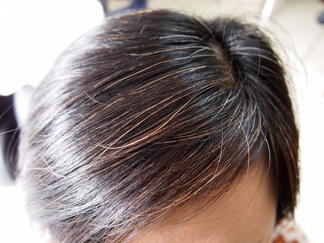 中医:头发病变与内脏状态有何关系?