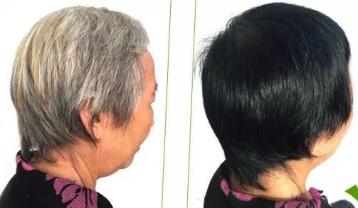 中医:头发病变与内脏状态有何关系?