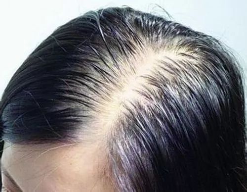 中医:头发病变与内脏状态有何关系?